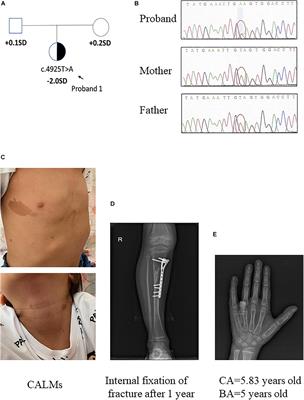 Characterization of Two Loss-of-Function NF1 Variants in Chinese Patients and Potential Molecular Interpretations of Phenotypes